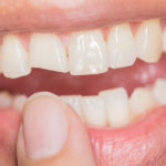 Woman pointing to her chipped tooth.
