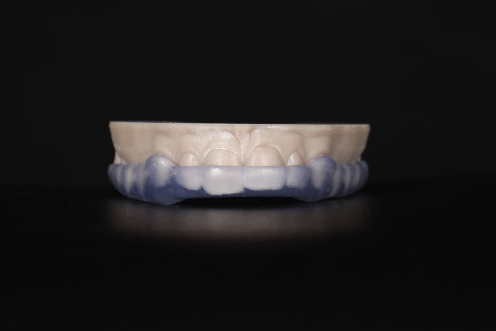 occlusal splint for teeth grinding placed onto a plaster model of upper teeth