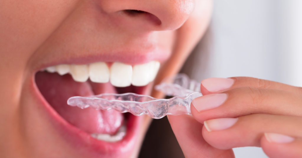 Close-up of woman's hand putting transparent aligner in teeth.