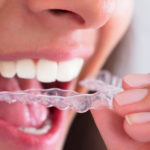 Close-up of woman's hand putting transparent aligner in teeth.