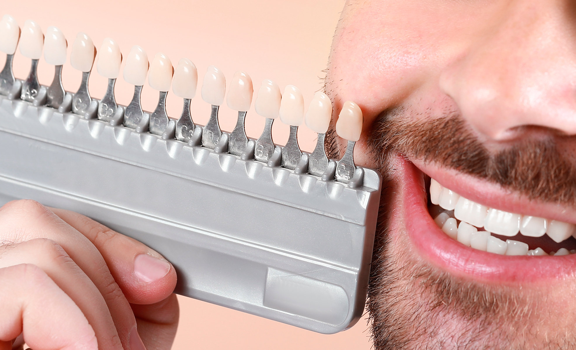 What Are Veneers, and Should You Get Them? A Guide Keppel Dental
