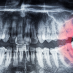 Teeth x-ray of wisdom tooth.