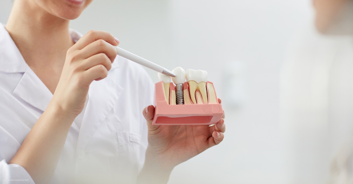 Yes, Dental Implants Can Fail Keppel Dental