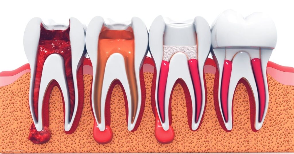 illustration of four teeth showing the progression of tooth health after a root canal treatment