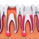 illustration of four teeth showing the progression of tooth health after a root canal treatment