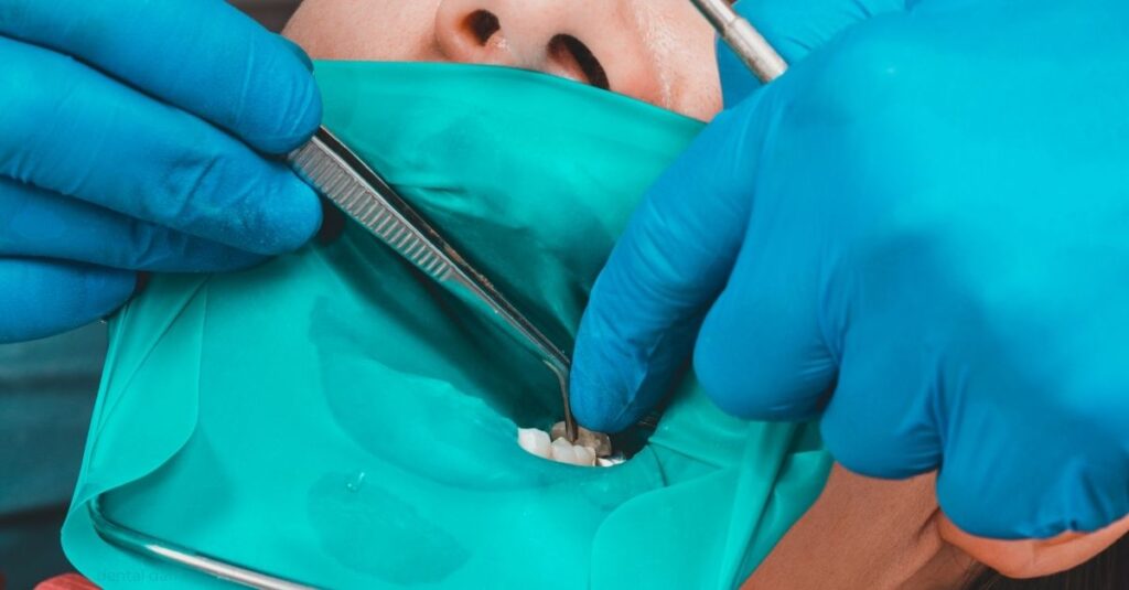 close up image of a person with a dental dam over their mouth while a dentist performs a root canal treatment