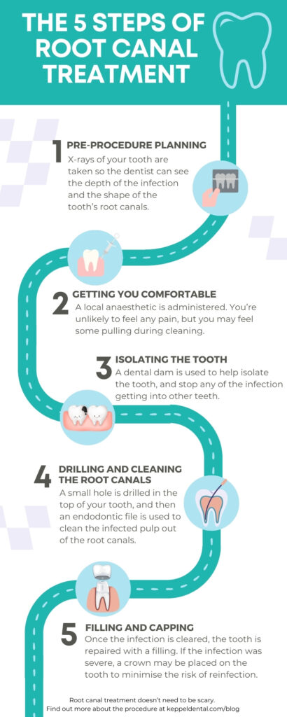 infographic explaining the 5 steps of root canal treatment