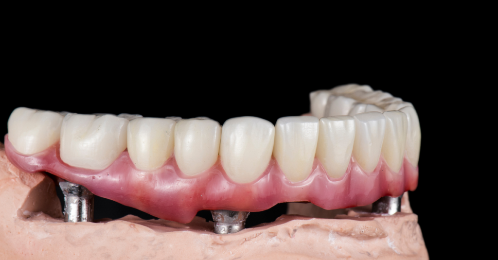 Row of dental implants painted.