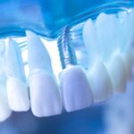 model of a mouth with teeth and a same day dental implant post