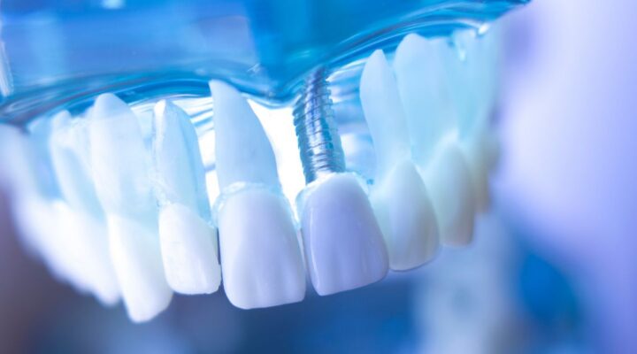 model of a mouth with teeth and a same day dental implant post